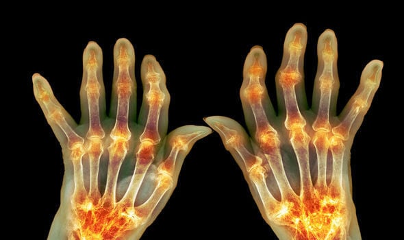 An X-ray-style image of both hands with joints highlighted in orange, illustrating arthritis or joint inflammation.